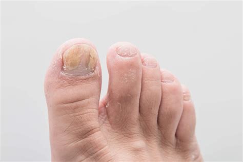 Aprender acerca 54 imagen como eliminar las uñas amarillas de los pies