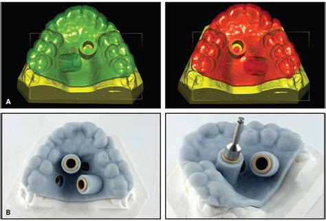 Bone First Principle With Cadcam Insertion Guides For Mini Implant