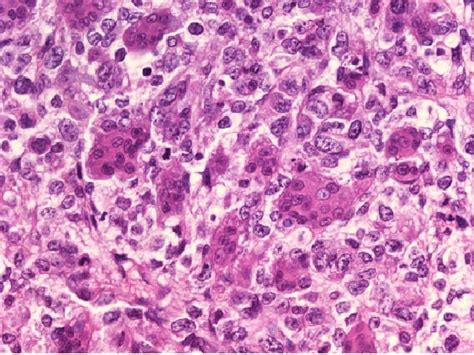 Nonsmall Cell Carcinoma Of The Lung With Osteoclast Like Giant Cells