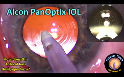 Alcon PanOptix Trifocal IOL Performance – Cataract Coach