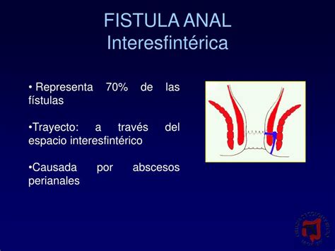 Ppt Conceptos Actuales En El Tratamiento De La Fistula Anal Powerpoint Presentation Id