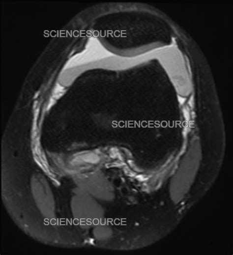 Hemarthrosis, MRI | Stock Image - Science Source Images