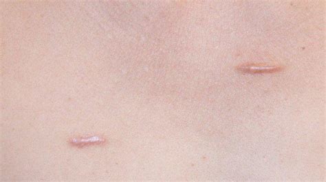 Mengenal Keloid Bekas Luka Abnormal Yang Dapat Terjadi Pada Anak Anak