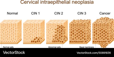 Cervical dysplasia cancer Royalty Free Vector Image