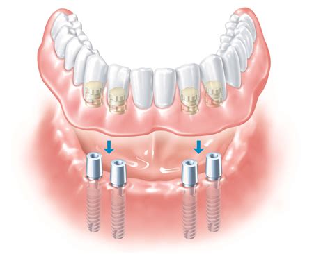 Denture Implant Newnham Dental