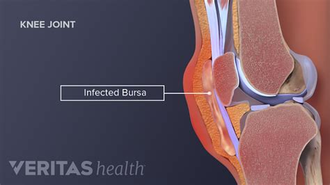 Knee (Prepatellar) Bursitis | Arthritis-health
