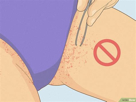 How To Get Rid Of Razor Bumps In The Bikini Area Easy Tips