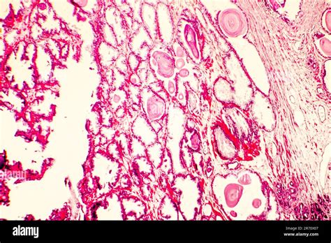 Hyperplasie De La Prostate Photomicrographe Montrant Les Glandes