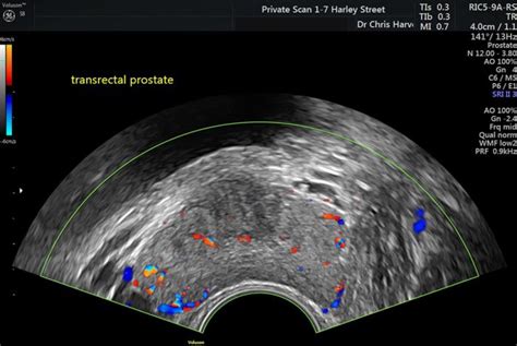 Prostate Ultrasound Scan Transrectal Private Ultrasound Scans London