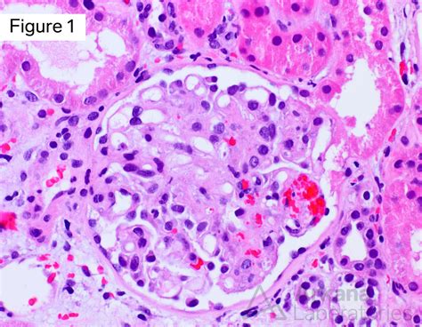 Thrombotic Microangiopathy Diagnose This Arkana Laboratories