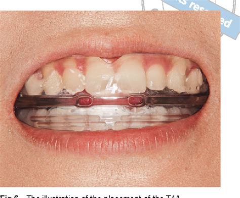 Figure 6 From Simple Myofunctional Therapy Using Ready Made Mouthpiece