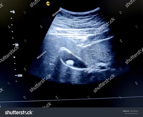 158 Gallbladder Ultrasond Stock Photos Images And Photography Shutterstock