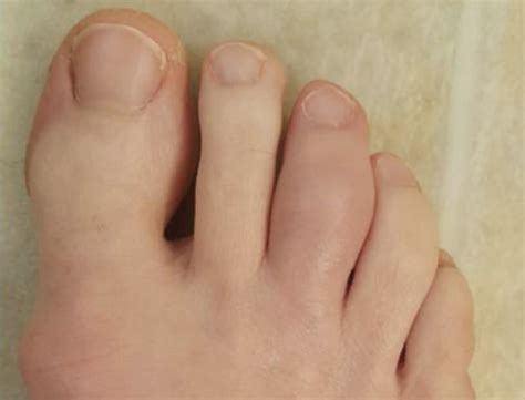 Second Toe Pain Causes And How To Get Relief Atelier Yuwaciaojp