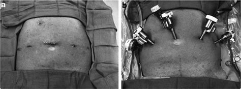 Patient positioning and port placement. (a) Port placement. (b) Port ...