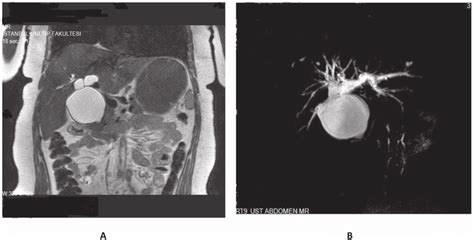 Cystic Duct Common Bile Duct