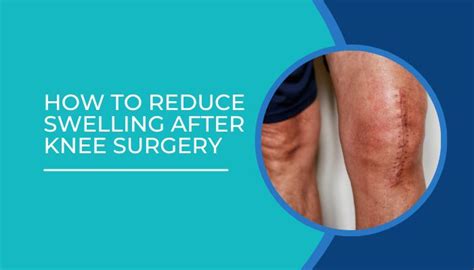 How To Reduce Swelling After Knee Surgery Dr Sartawi