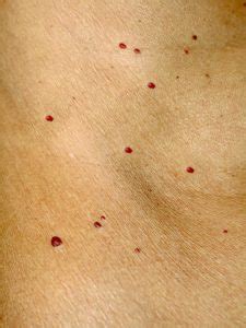 Cherry Angioma What Do Red Moles Mean And Are They Dangerous