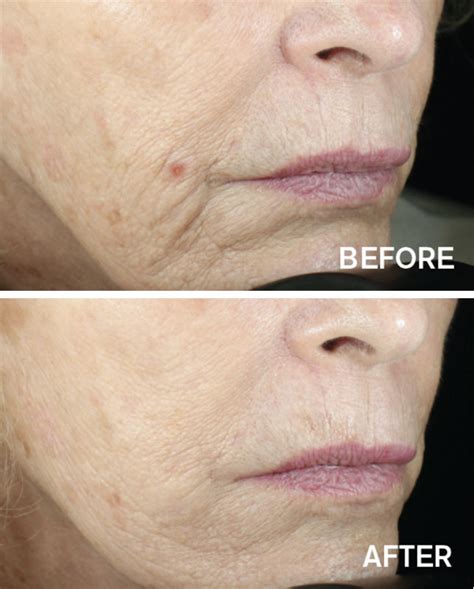 Before And After Vivace Rf Microneedling Aivi Aesthetics Skin Health