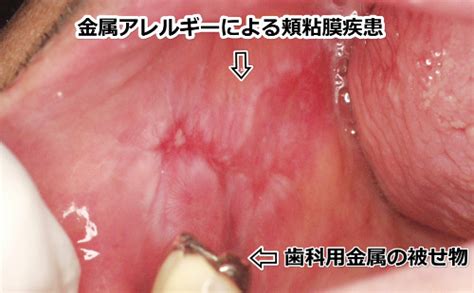 金属アレルギー | 新枝歯科医院｜高松市 春日町 東山崎町 歯科医院 歯医者