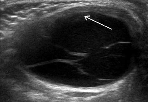 B Ultrasonography Of The Right Testis Showing A Cystic Mass With