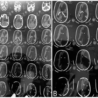 A B CT Scan Brain Plain Axial Views Showing Gross Hydrocephalus