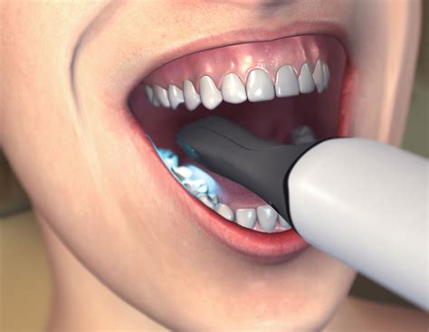 The Current State Of Digital Impression Systems In Dentistry August