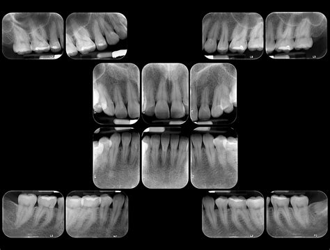 Radiograf As Intraorales Rxm Radiologia Maxilofacial