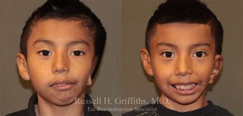 Case 1 One Stage Microtia Reconstruction For Hemifacial Microsomia Before And After Gallery