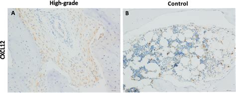 Modest CXCL12 Immunohistochemical Staining In OS Two Of Five A