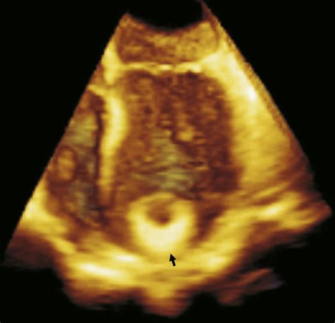 A Large Cardiac Papillary Fibroelastoma Arising From The Coumadin Ridge