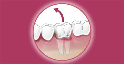 Tooth Extraction Simple Vs Surgical Tooth Removal Aaoms