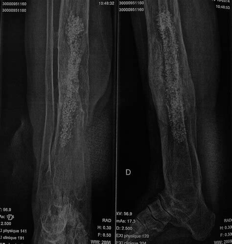 Bioactive Glass For Long Bone Infection A Systematic Review Injury