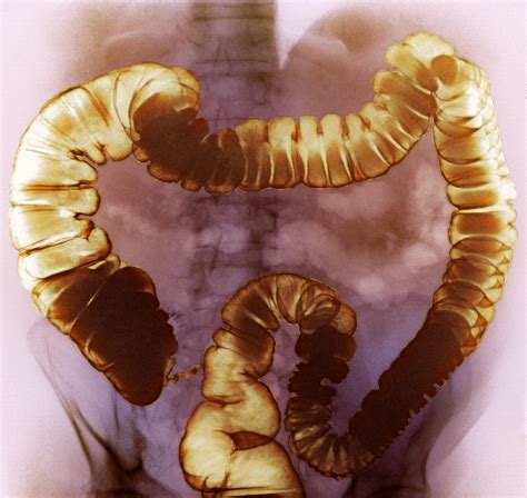 Large Intestine X Ray Photograph By Cnri Pixels