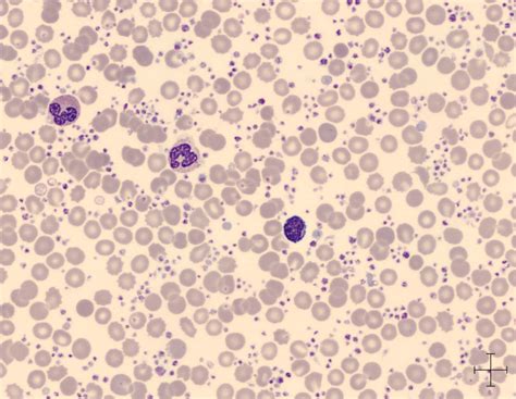 Plaquetas No Sangue Alta - Contagem De Plaquetas Altas - RETOEDU