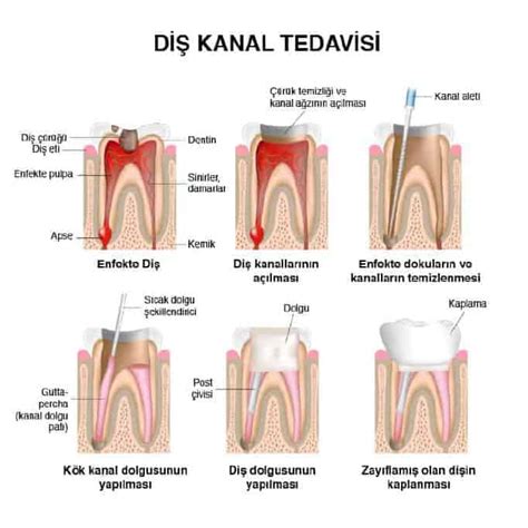 Diş Kanal Tedavisi Nedir Nasıl Yapılır