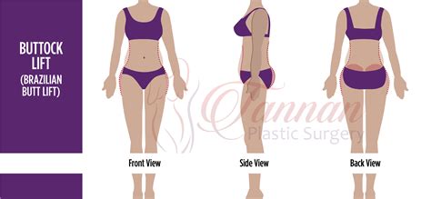 Nicki Minaj Booty Implants Before And After