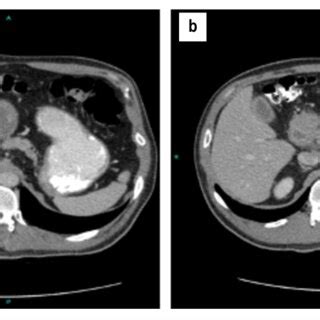 A Axial Abdominal Computed Tomography With Contrast Shows Thickening