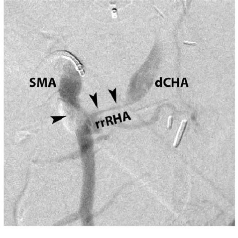 Superior mesenteric artery (SMA) arteriogram in the left oblique... | Download Scientific Diagram