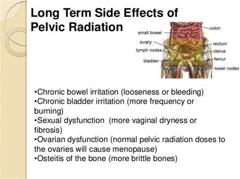 Radiation For Cervix Cancer