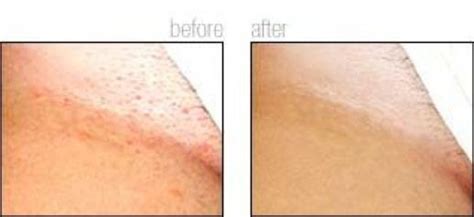 Before And After Bikini Line Laser Hair Removal Hairremoval Hair Removal Before And After