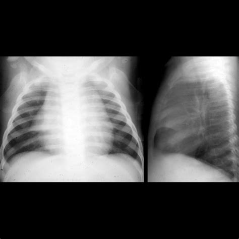 Normal Thymus Pediatric Radiology Reference Article Pediatric