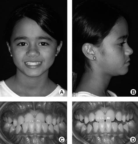 A And B Initial Extraoral Photographs C Initial Intraoral