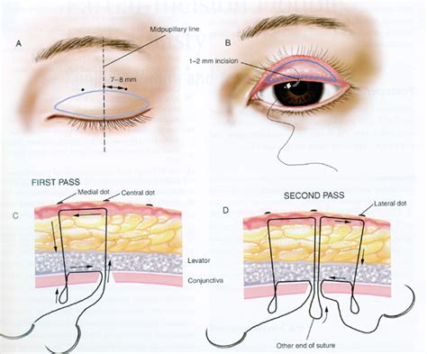 Eyelid Surgery By Prof Dr Cn Chua Different Suture Techniques For