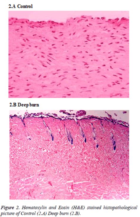 Role Of Stromal Vascular Fraction In Severe Burn Wound Healing Process