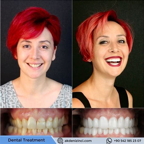 Galer Antalya Dental Clinic Antalya Dental Treatment