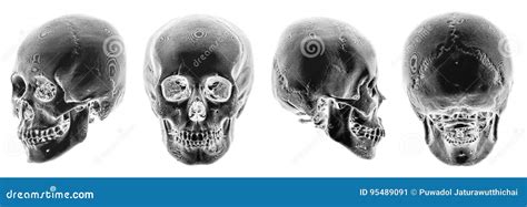 3d Ct Scan Of Human Skull Multiple View Invert Color Style Stock