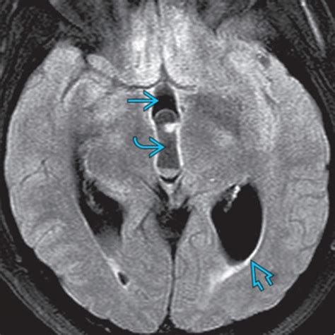 Ventricular System Overview Brain Imaging