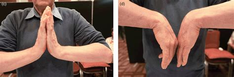 Dorsiflexion Of Wrist