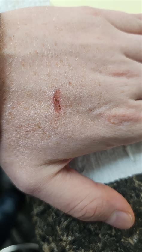 Sulfuric Acid Burns Skin