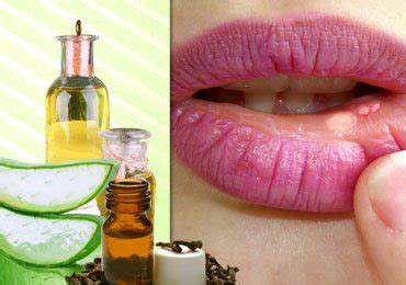 Home Remedies for Mouth Sores or Canker Sores